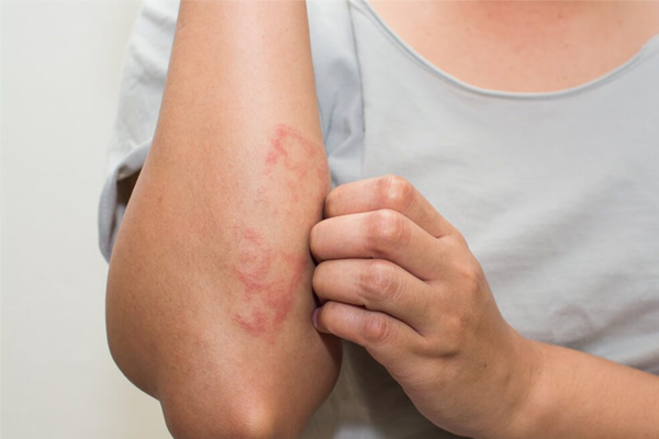 Skin Diseases